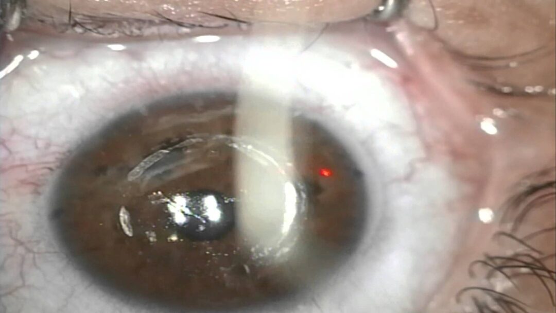Operación láser en los ojos