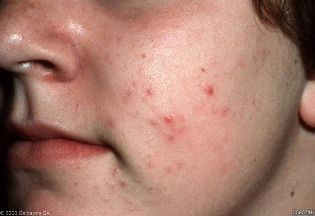 Espinillas y otros tipos de acné
