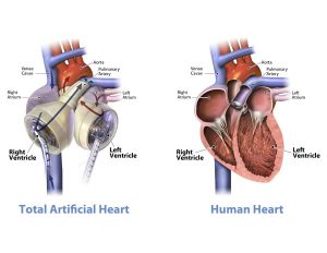 Corazón artificial de Syncardia Systems